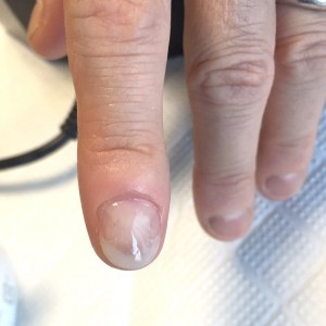 むしり癖による爪の形のお悩み（自爪状態：重度）自爪育成4回目の施術後