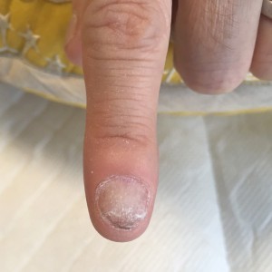 むしり癖による爪の形のお悩み（自爪状態：重度）自爪育成4回目の施術前