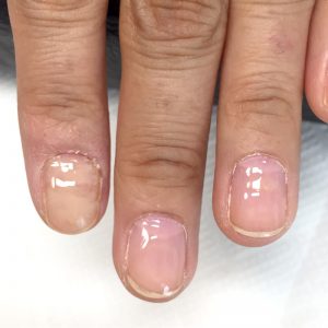 皮膚疾患の後遺症による爪の変形（自爪状態：中度）自爪育成施術前